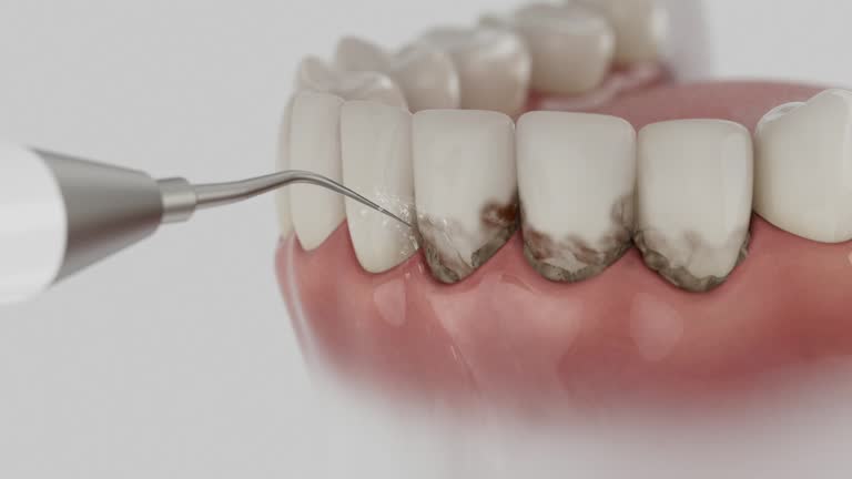 Trusted Wisdom Tooth Removal service in Pleasant Run Farm, OH - Dentist Open Now